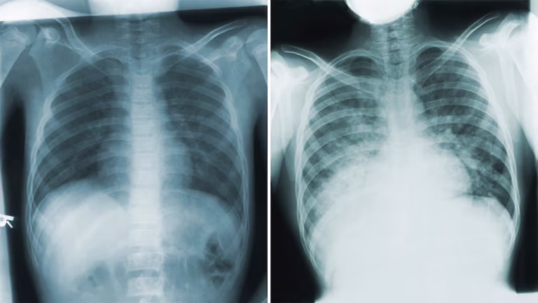 Cuadro de rayo X sobrepeste neumónics en Arizona