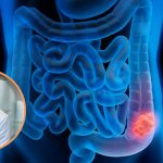 Por qué crecen los diagnósticos de cáncer colorrectal antes de los 40 años: estos son los síntomas de alerta